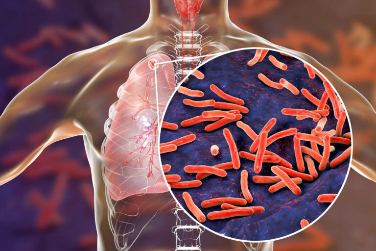 Public Urged to Undergo TB Screenings to Prevent Spread